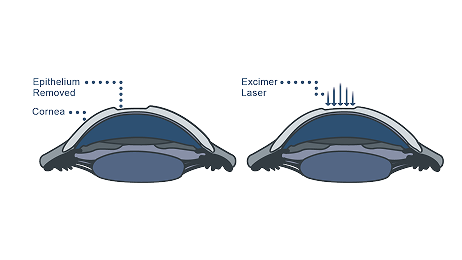 Customised Trans Epithelial No touch (cTEN) laser technique