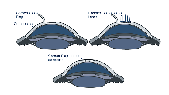 Laser Assisted In situ Keratomileusis (LASIK)