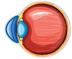 Keratoconus