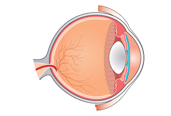 cross-linking eye surgery adelaide, corneal cross linking, keratoconus treatment, corneal strengthening