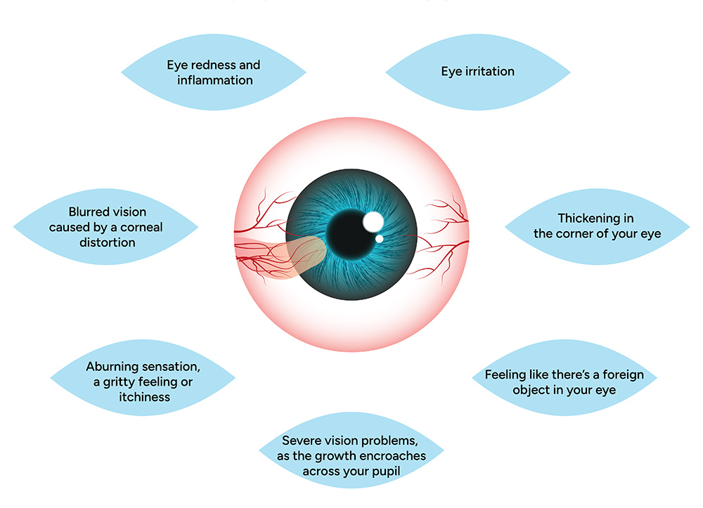 pterygium treatment adelaide, eye irritation, red eye, dry eye symptoms