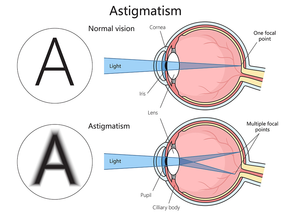 can glasses help with astigmatism, glasses for astigmatism, astigmatism correction glasses, blurry vision treatment