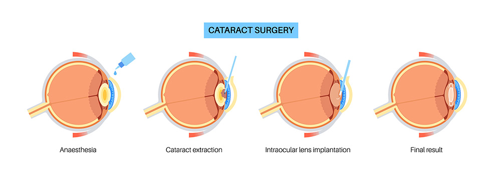 how is cataract surgery done, phacoemulsification, ultrasound cataract surgery, cloudy lens