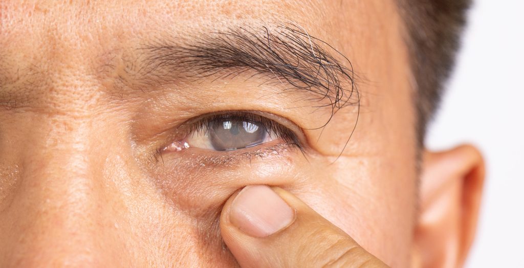 how is cataract surgery done cataract surgery how cataract surgery works cataract procedure