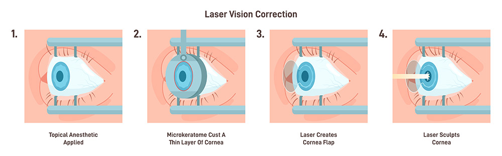 benefits of laser eye surgery, laser vision correction, reduce dependence on glasses, laser eye surgery Adelaide