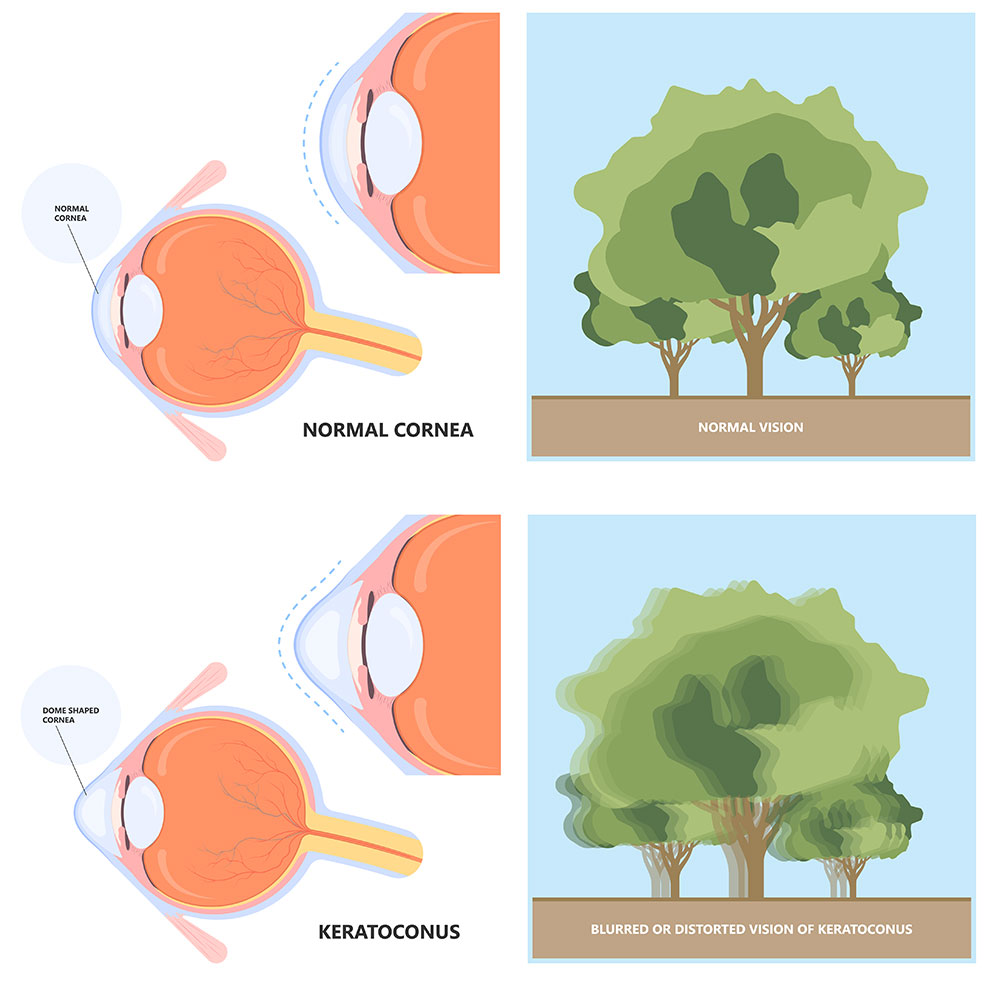 keratoconus symptoms, blurred vision, distorted vision, corneal thinning