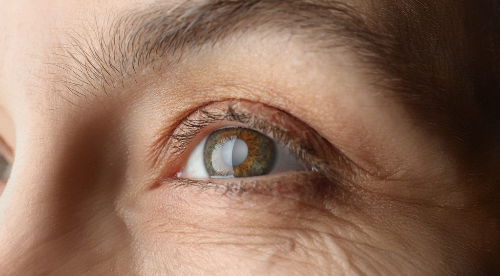 how long between cataract surgery on each eye, second-eye cataract surgery, cataract surgery recovery, cataract surgery timing