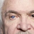 glaucoma vs cataracts, cataract symptoms, glaucoma symptoms, optic nerve damage