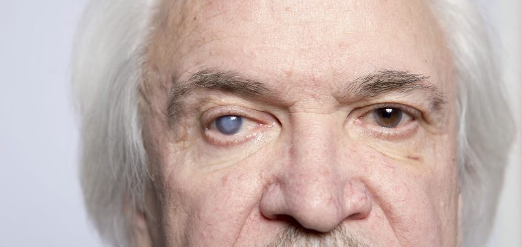 glaucoma vs cataracts, cataract symptoms, glaucoma symptoms, optic nerve damage