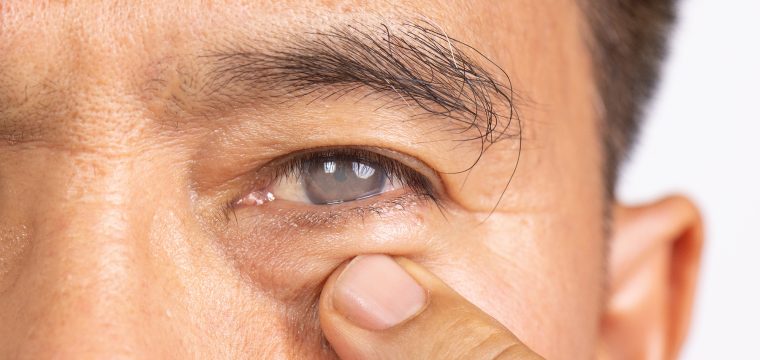 how is cataract surgery done cataract surgery how cataract surgery works cataract procedure