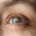 how long between cataract surgery on each eye, second-eye cataract surgery, cataract surgery recovery, cataract surgery timing