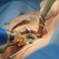 safety of laser eye surgery